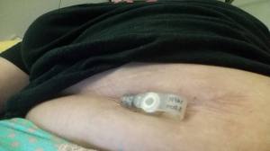 Mace Colon MACE and Cecostomy | Bowel Management for Spina Bifida